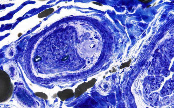 2E3 Amyloid Neuropathy (Case 2) Plastic 60X 1