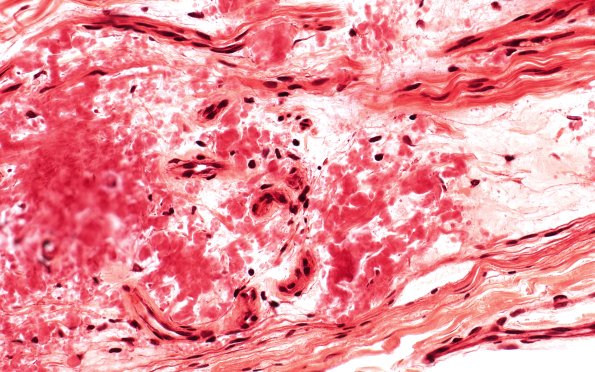 3B1 Amyloid neuropathy (Case 3) CR 40X