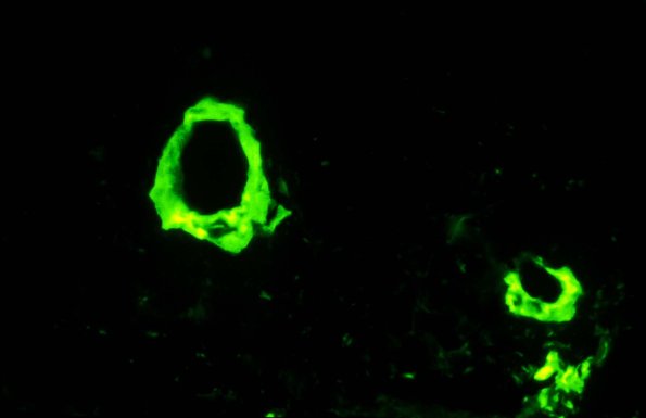 3C Amyloid Neuropathy (Case 3) Anti-kappa - Copy