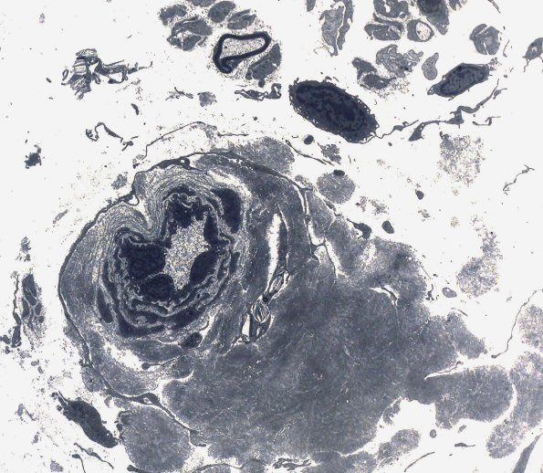 3D1 Amyloid neuropathy (Case 3) EM 2 - Copy