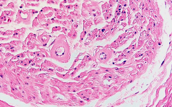 4A2 Amyloid Neuropathy (Case 4) H&E 60X