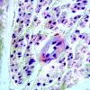 4C3B-Amyloid-Neuropathy-Case-4-CR-33.jpg