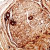 4D2-Amyloid-Neuropathy-Case-4-Blood-Dyscrasia-Lambda-IHC-40X.jpg