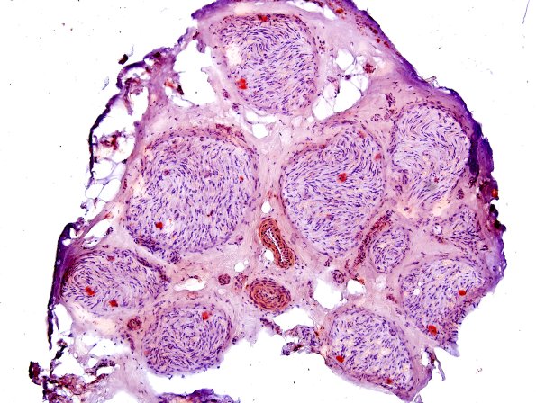 5B Amyloid NP (Case 5) Congo Red 4