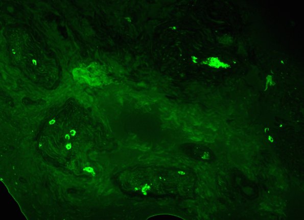 5C1 Amyloid NP (Case 5) 94 - Copy
