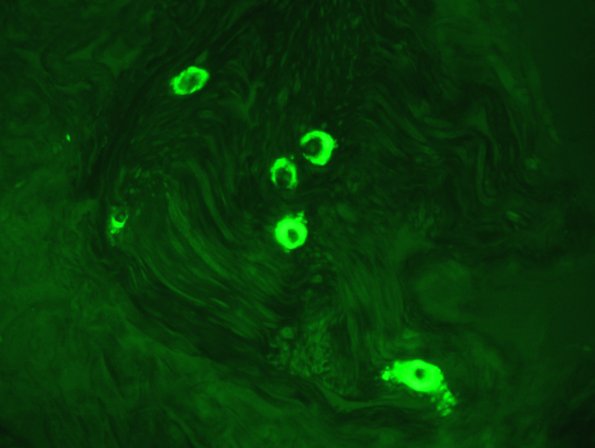5C2 Amyloid NP (Case 5) 95 - Copy