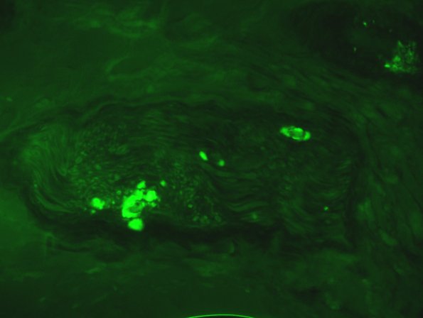 5C3 Amyloid NP (Case 5) 96 - Copy
