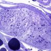 6B1-Amyloid-Neuropathy-Case-6-Plastic-2.jpg