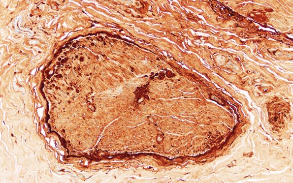 7C2 Amyloid neuropathy (Case 7) Lambda IHC 1A