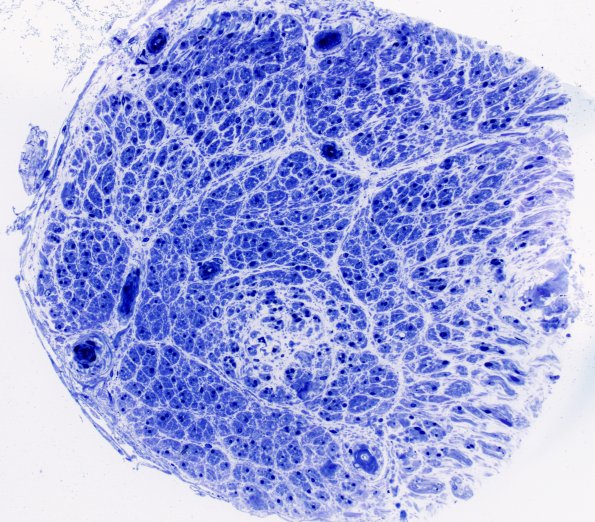 7D1 Amyloid neuropathy (Case 7) Plastic 6