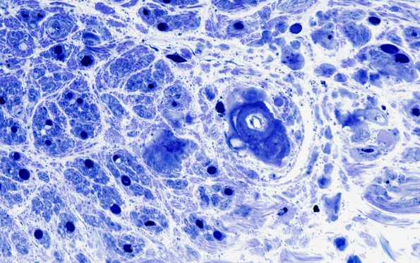 7D2 Amyloid neuropathy (Case 7) Plastic 8