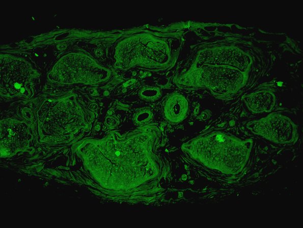 8B1 Amyloid NP (Case 8) Thioflavin 4 - Copy