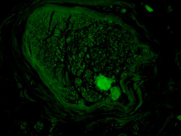 8B2 Amyloid NP (Case 8) Thioflavin 2 - Copy