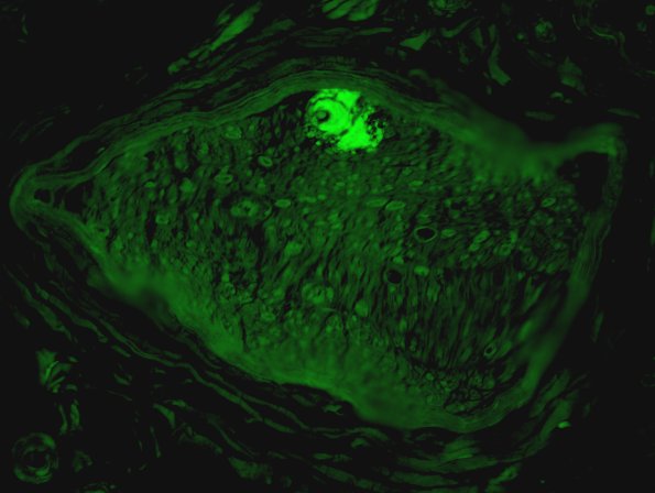 8B3 Amyloid NP (Case 8) Thioflavin 3 - Copy