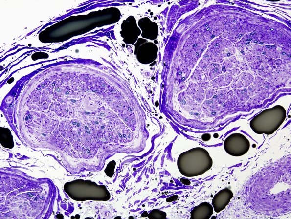 8C1 Amyloid NP (Case 8) Plastic 3