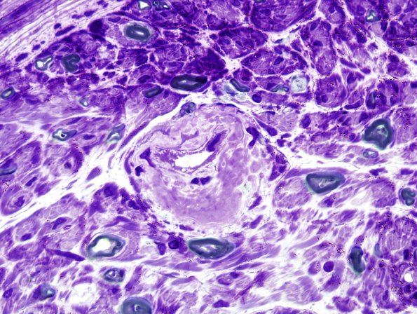 8C3 Amyloid NP (Case 8) Plastic