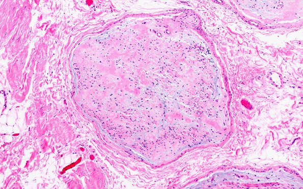 9A2 Amyloid NP (Case 9) H&E 4