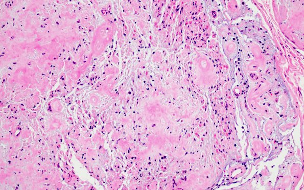 9A4 Amyloid NP (Case 9) H&E 6