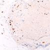 9B1 Amyloid NP (Case 9) CD3 20X