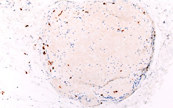 9B1 Amyloid NP (Case 9) CD3 20X