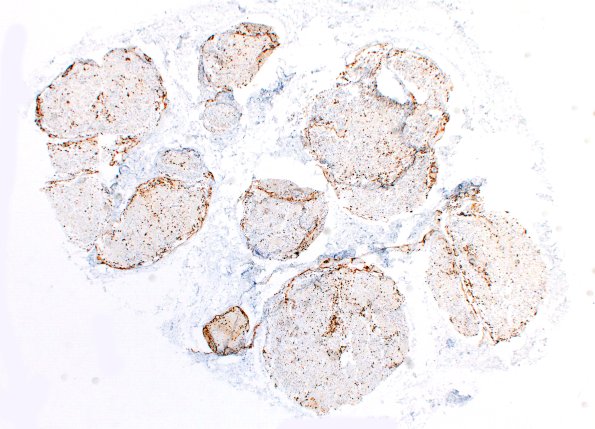 9B2 Amyloid NP (Case 9) CD138 2X
