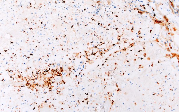 9B3 Amyloid NP (Case 9) CD138 20X