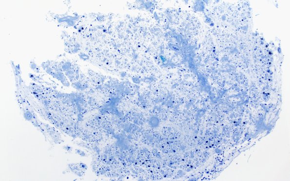 9D1 Amyloid NP (Case 9) Plastic 10X 1