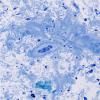 9D2 Amyloid NP (Case 9) Plastic 40X 1