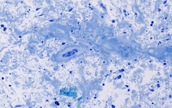 9D2 Amyloid NP (Case 9) Plastic 40X 1