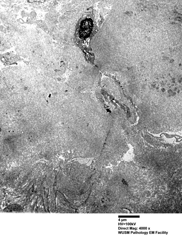 9E1 (Case 9) Nerve with Amyloid_001 - Copy