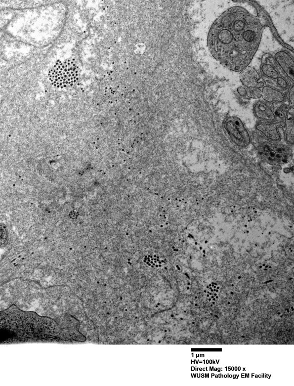 9E2 (Case 9) Nerve with Amyloid_009 - Copy