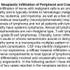 0A Neuropathy due to Neoplastic Infiltration - Text