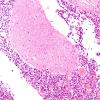 11B3-Acute-monocytic-leukemia-Case-11-III-nerve-H-E-2.jpg