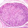 2A5Lymphoma-Case-2-H-E3-6.jpg