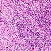 2A6-Lymphoma-Case-2-H-E3-1.jpg