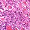 2B3-Lymphoma-Case-2-H-E3-14.jpg