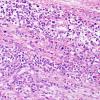 6A6 Neurolymphomatosis (Case 6) H&E 3
