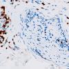 7B2 Lymphoma, sural nerve (PNS) (Case 7) CD3 20X 1