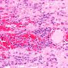 8A3 Neurolymphomatosis, nerve, Mantle Cell (Case 8) H&E 40X 2