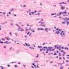 8A4 Neurolymphomatosis, nerve, Mantle Cell (Case 8) H&E 60X