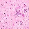 1C7 Paraneoplastic anti-Hu (Case 1) Hippocampus 1