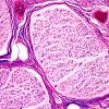 9A3-Paraneoplastic-NP-Case-9-HFB-3.jpg