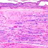 9A4-Paraneoplastic-NP-Case-9-HFB-1.jpg