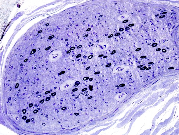 10A1 Diabetic neuropathy (Case 10) Plastic 3 | 1 Symmetrical ...