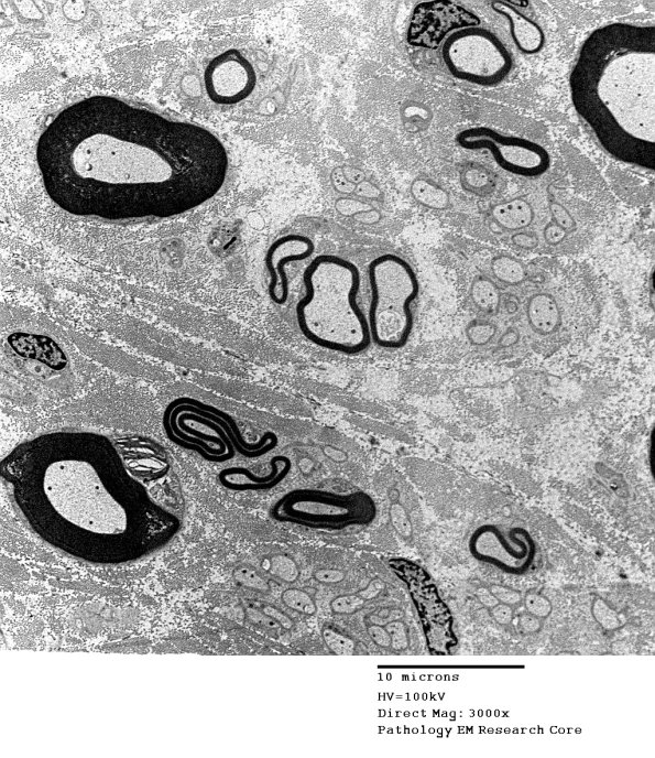 1E1 Diabetes (S13-1715) - Copy