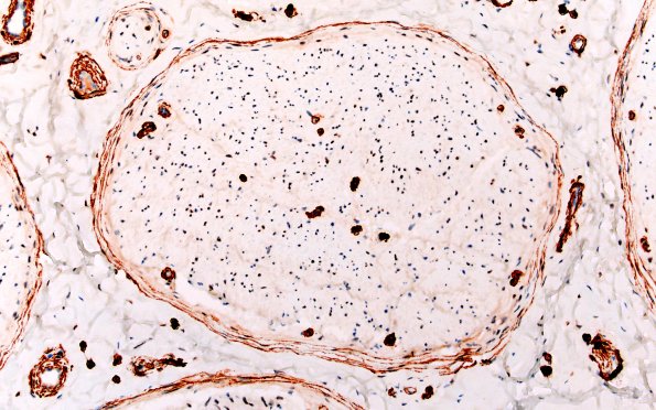 2C2 (Case 2) SMA 20X