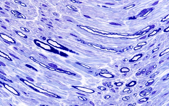 3A6 B3250 Diabetes 40X 1