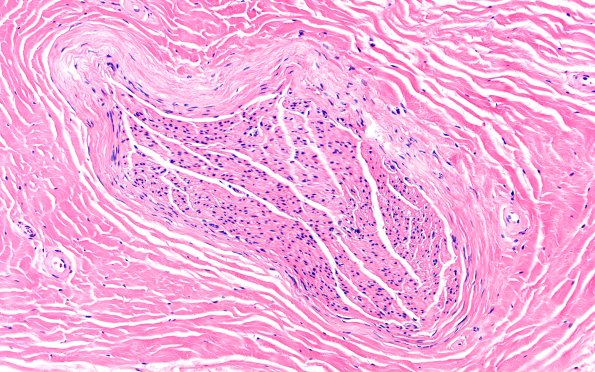 5A2 SSN (Case 5) 20X