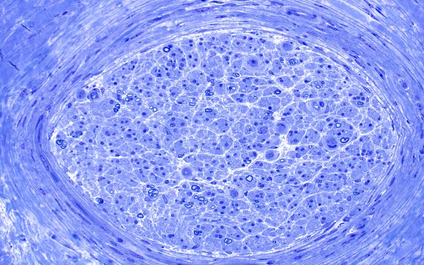 5B2 Epineurial (Case 5) 40X
