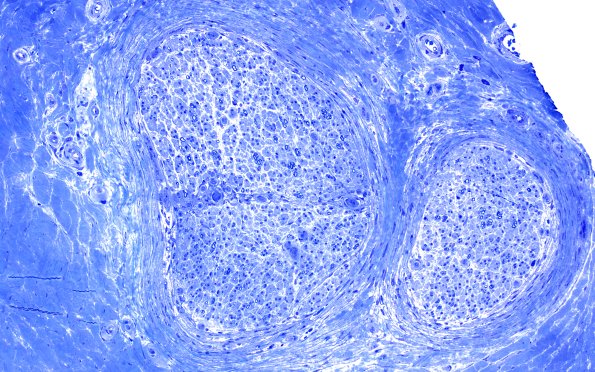 5B3 (Case 5) Plastic 9